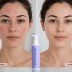Crème de nuit réparatrice pour peaux sensibles et rougeurs, avant et après application sur peau améliorée.